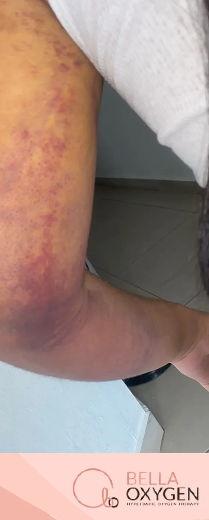 After: arm bruising at Bella Oxygen