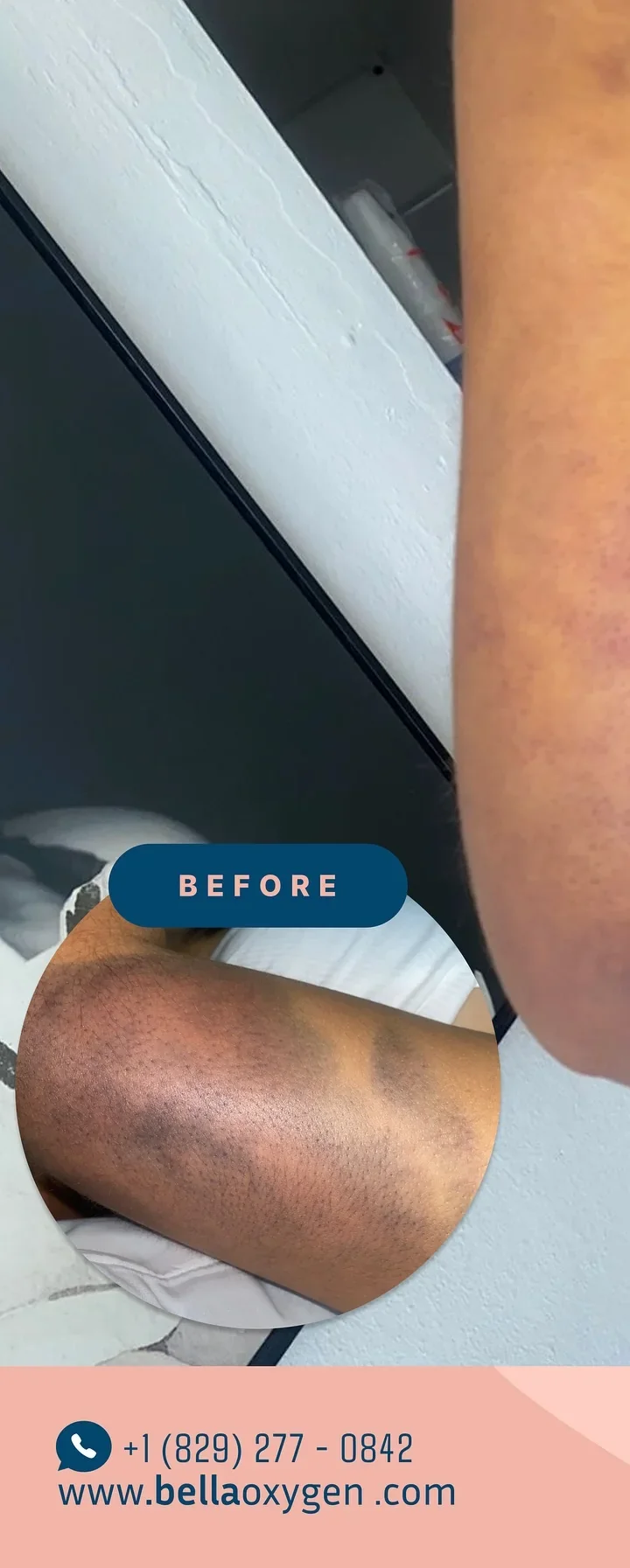 Before: arm bruising at Bella Oxygen