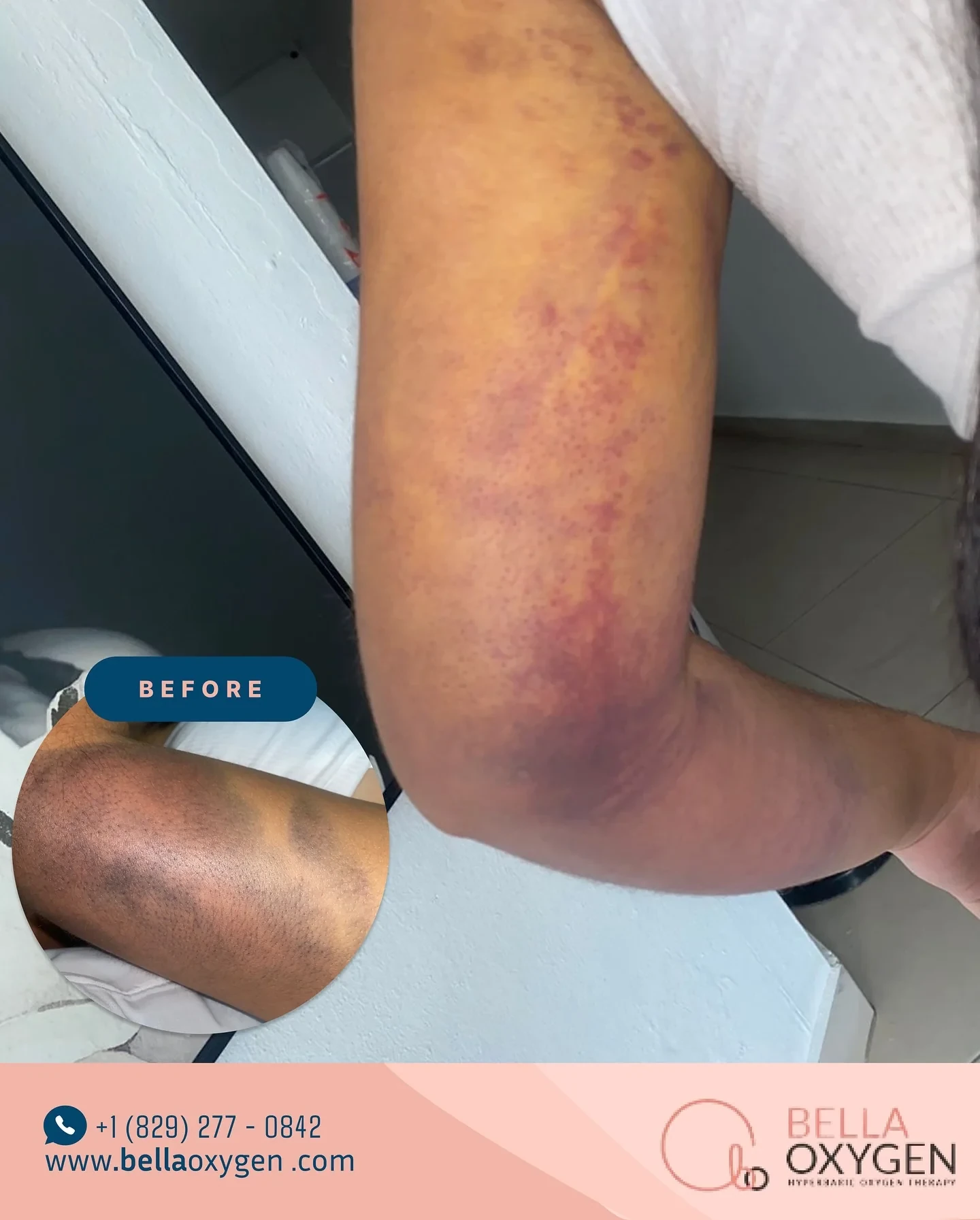 Bella Oxygen before-and-after comparison showing bruising on an arm and later healing