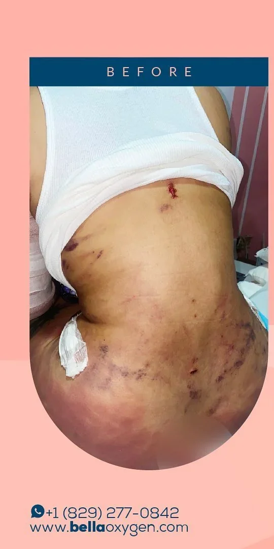 Before: back and buttock bruising at Bella Oxygen