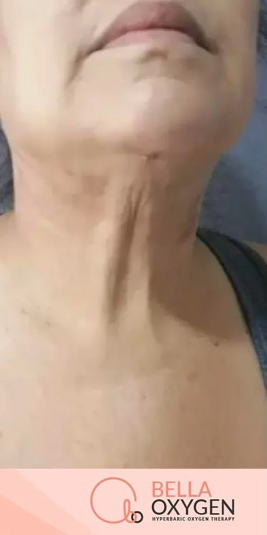 After: neck and chin bruising at Bella Oxygen