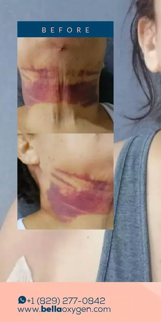 Before: neck and chin bruising at Bella Oxygen