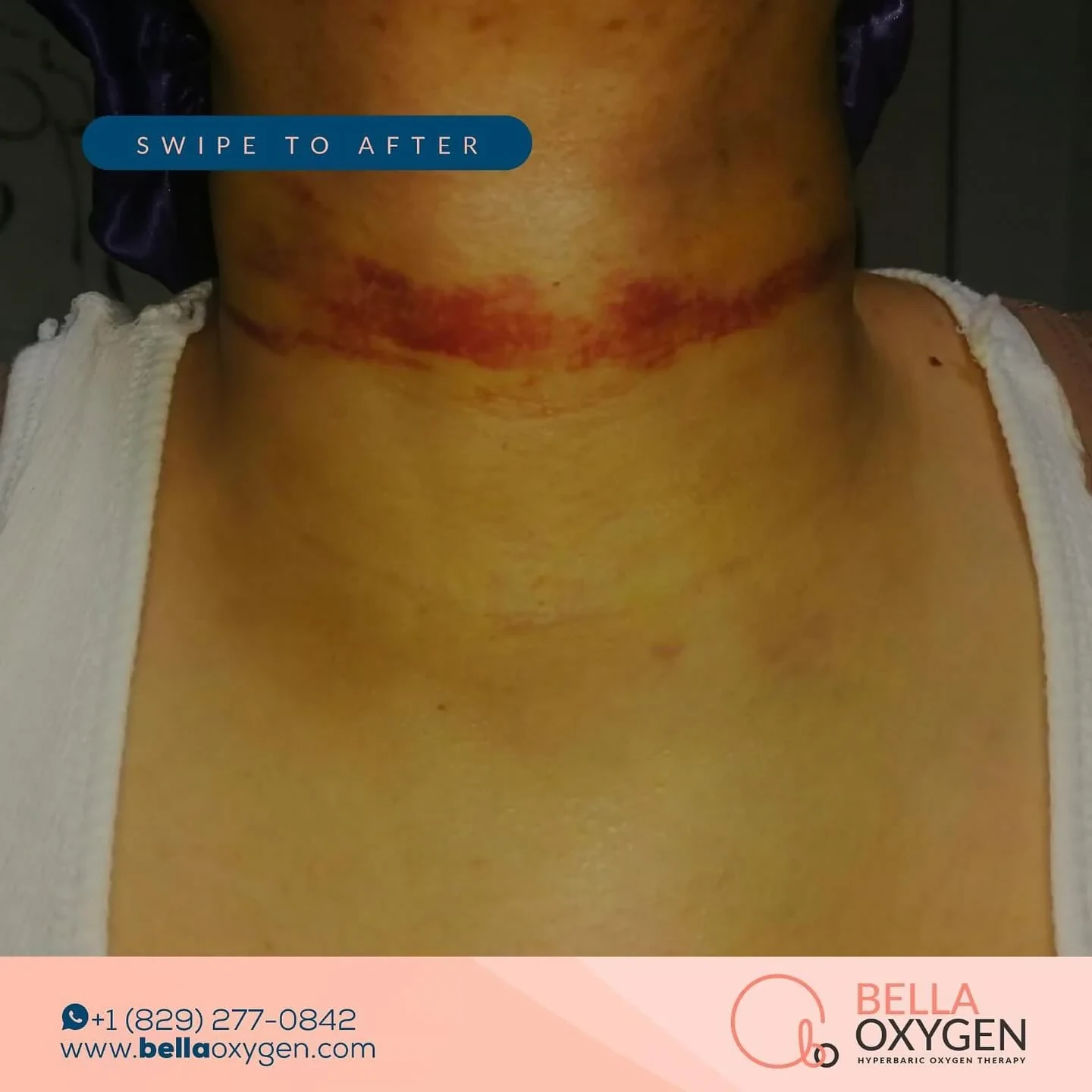Before photo showing post-surgical bruising across the neck and upper chest