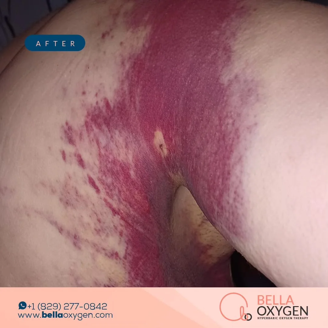 After: torso bruising at Bella Oxygen