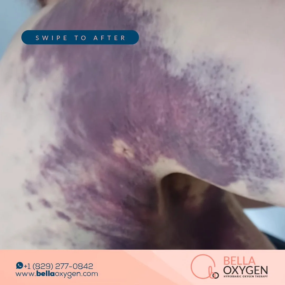 Before: torso bruising at Bella Oxygen