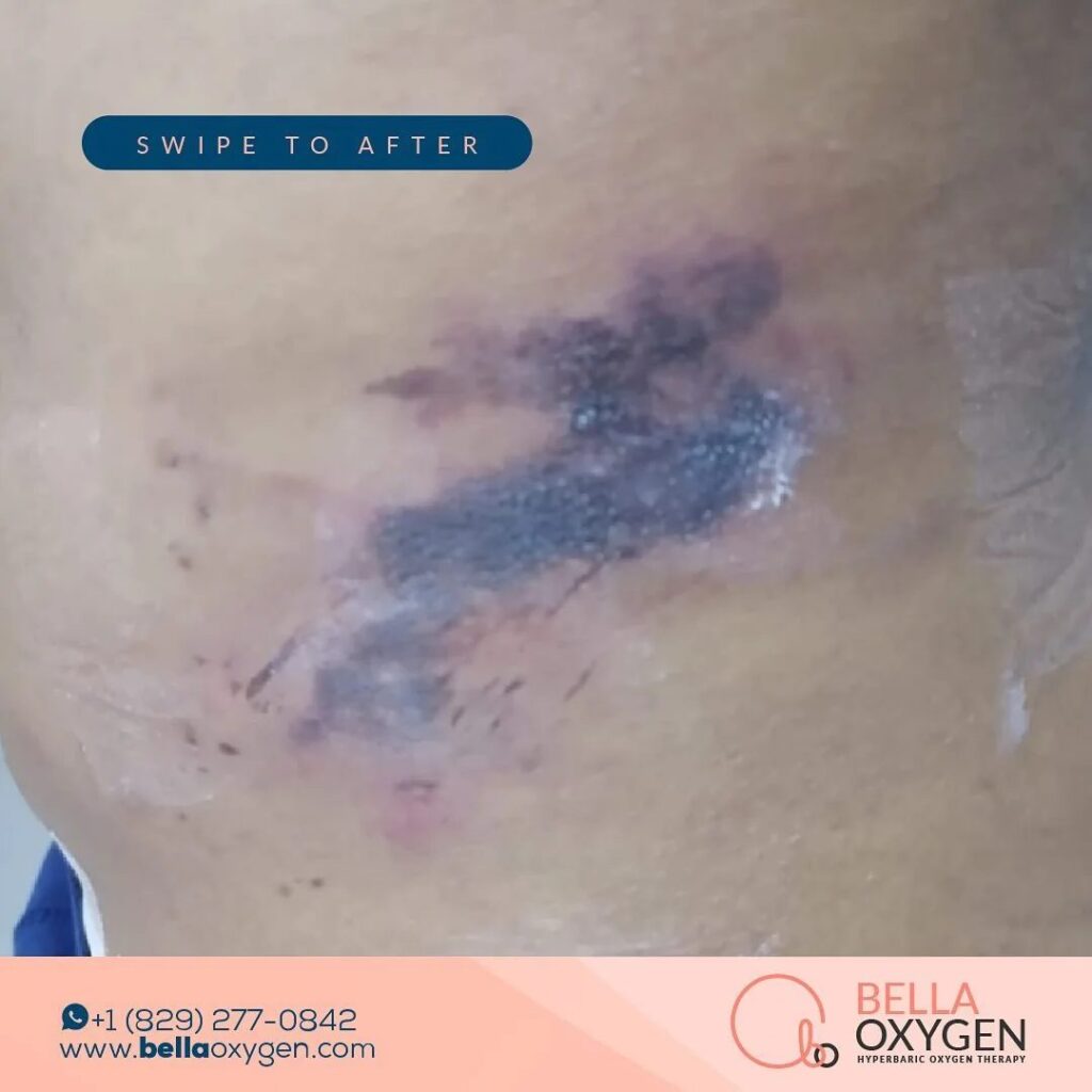 Clinic photograph documenting abdomen and hip bruising before later recovery
