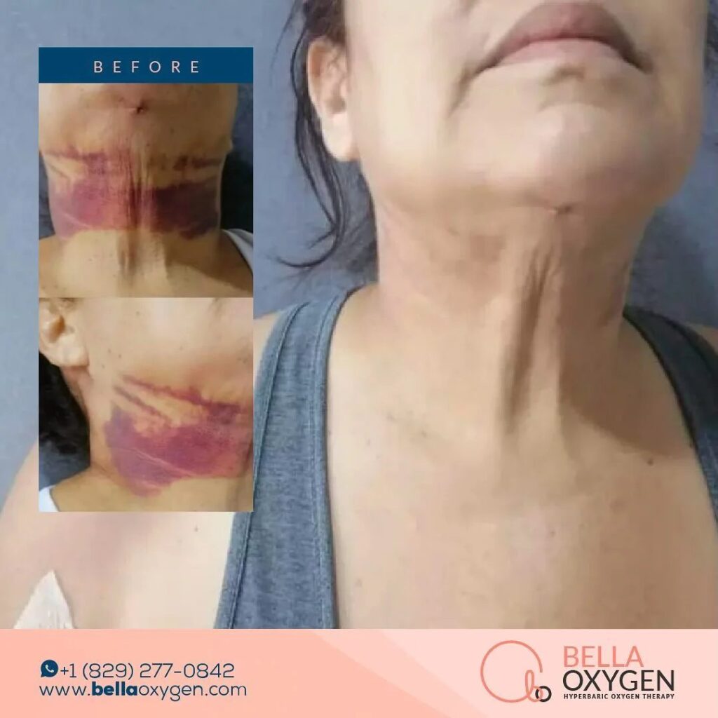 Bella Oxygen before-and-after comparison showing neck and chin bruising at two recovery stages