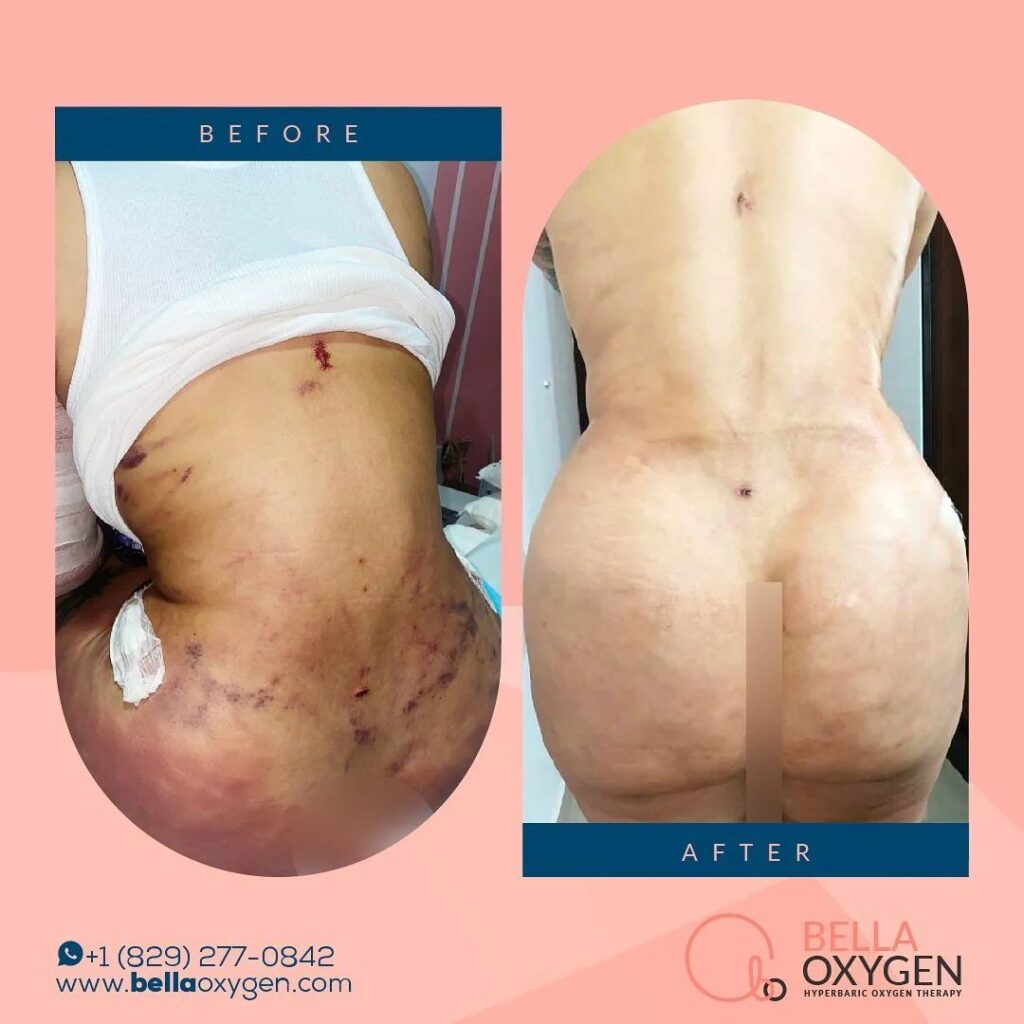 Bella Oxygen side-by-side comparison showing back and buttock bruising at two recovery stages