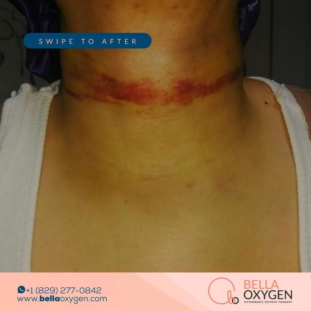 Clinic photograph documenting neck and chest bruising during recovery